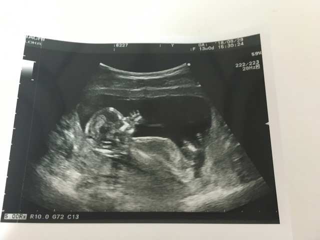 エコ―写真 13週0日 13w0d・男の子,妊娠13週,エコー,
