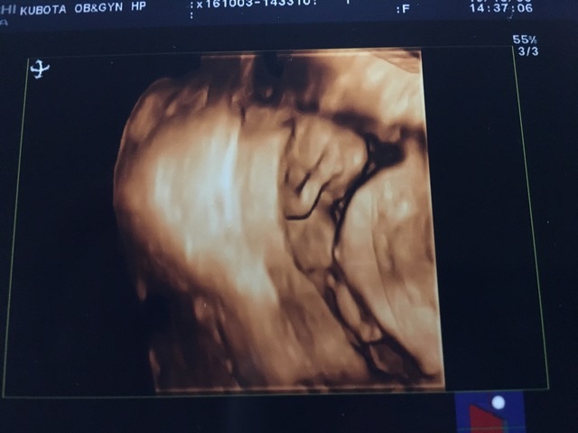 エコー写真 13週1日 13w1d 男の子,妊娠13週,エコー,