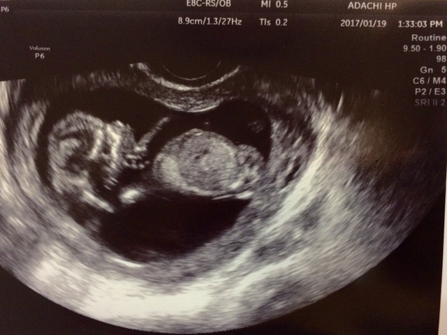 エコー写真 13週2日 13w2d 男の子,妊娠13週,エコー,