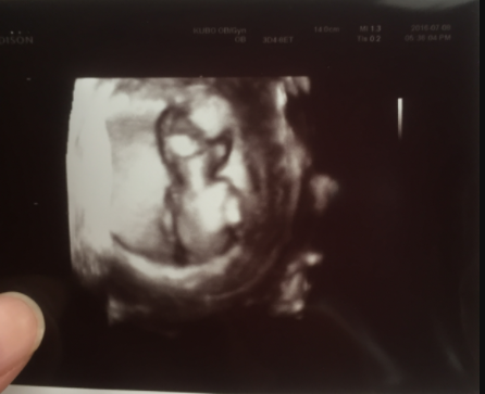 エコー写真 13週3日 13w3d 女の子,妊娠13週,エコー,