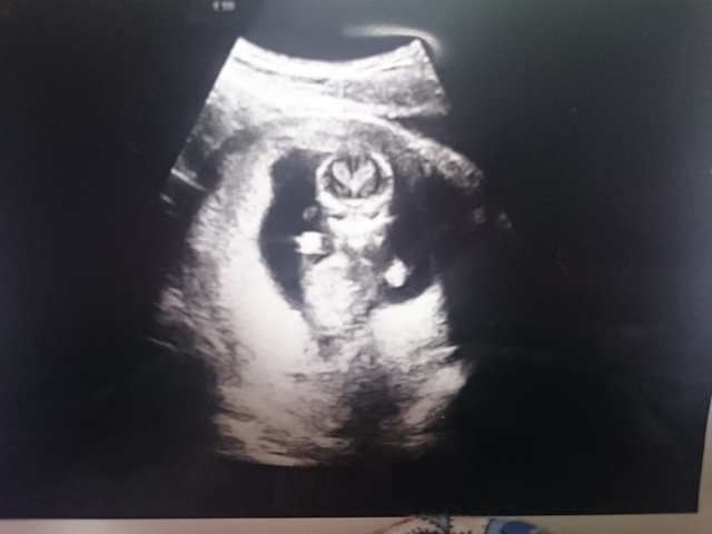 エコー写真 13週3日 13w3d 性別不明,妊娠13週,エコー,