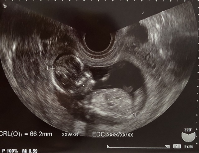 エコー写真 13週3日 13w3d 性別不明,妊娠13週,エコー,