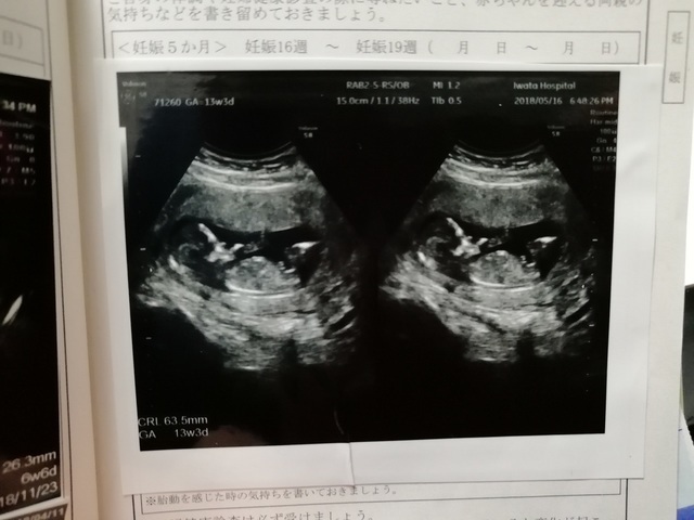 エコ―写真 13週3日 13w3d・男の子,妊娠13週,エコー,