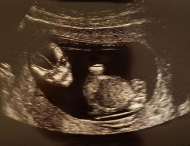 エコ―写真 13週3日 13w3d・男の子,妊娠13週,エコー,