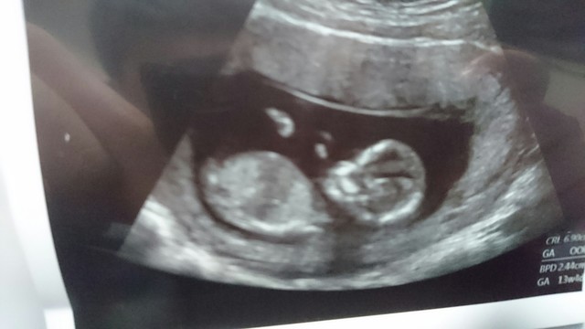 エコ―写真 13週4日 13w4d・女の子,妊娠13週,エコー,