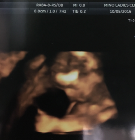 エコー写真 13週6日 13w6d 女の子,妊娠13週,エコー,