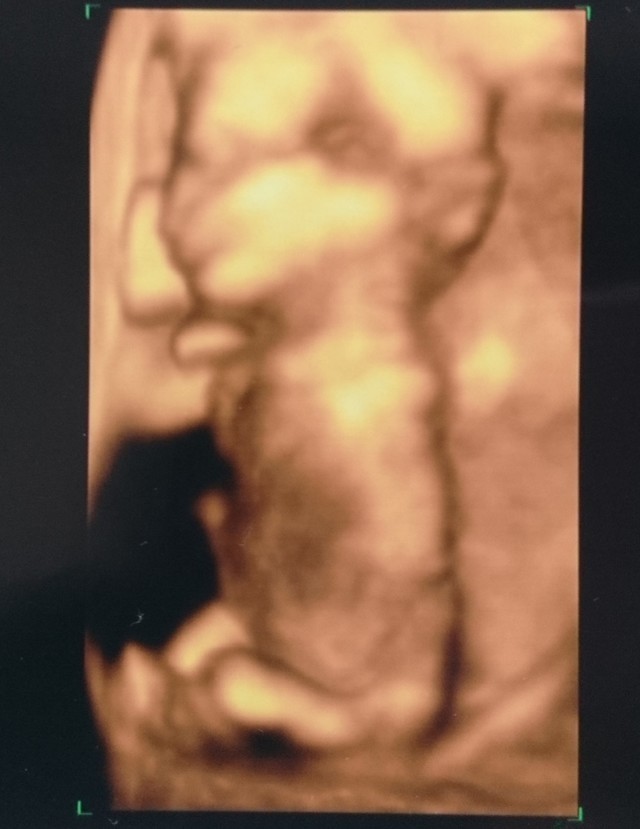 エコ―写真 13週6日 13w6d・女の子,妊娠13週,エコー,