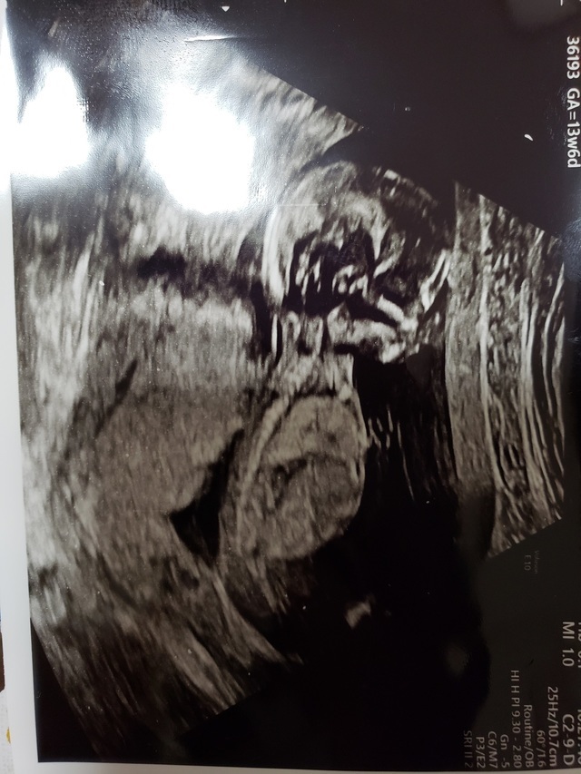 エコ―写真 13週6日 13w6d・性別不明,妊娠13週,エコー,