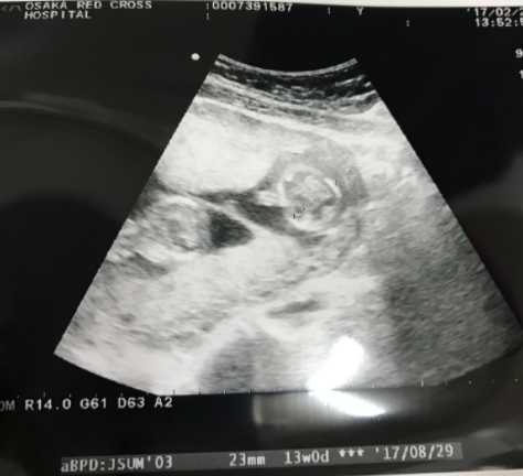 エコー写真 13週1日 13w1d 女の子,妊娠13週,エコー,