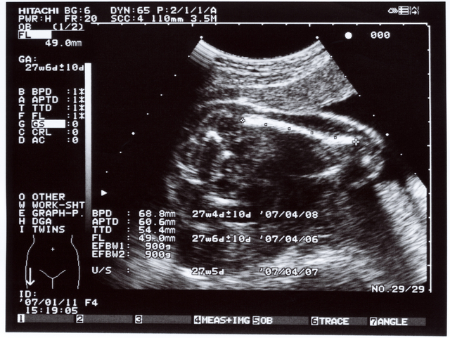 27週頃のエコー写真イメージ,27週,胎児,