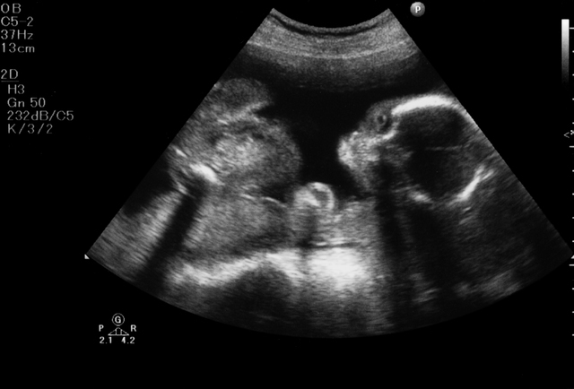 妊娠6ヶ月 エコー,妊娠,6ヶ月,赤ちゃん