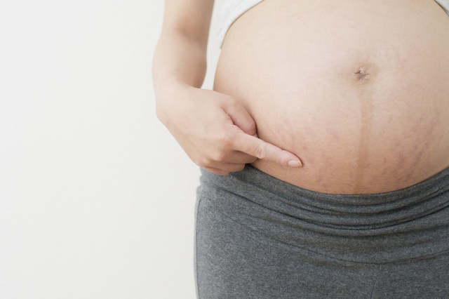 妊娠線,妊娠線,オイル,マタニティ