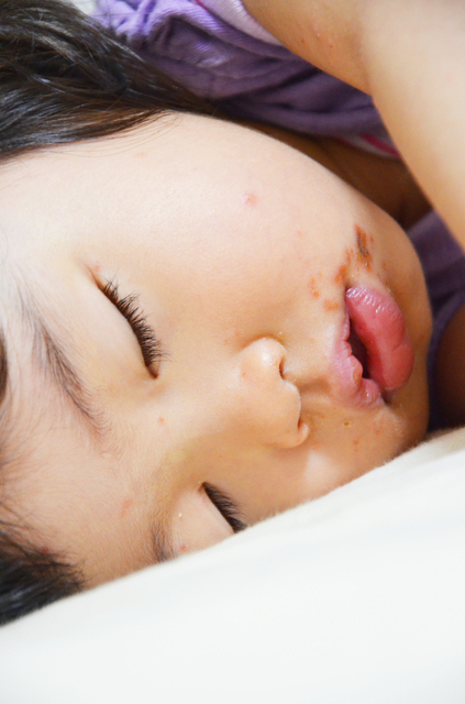 手足口病,赤ちゃん,手足口病,