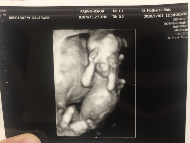 エコ―写真 15週0日 15w0d 男の子 ,妊娠,15週,エコー写真