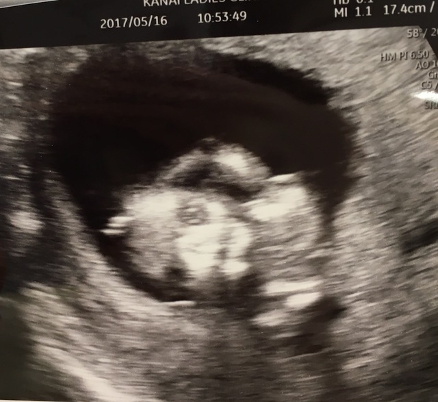 エコー写真 15週0日 15w0d 男の子,妊娠,15週,エコー写真