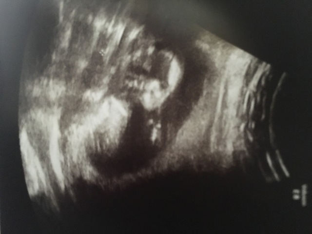 エコー写真 15週0日 15w0d 男の子,妊娠,15週,エコー写真