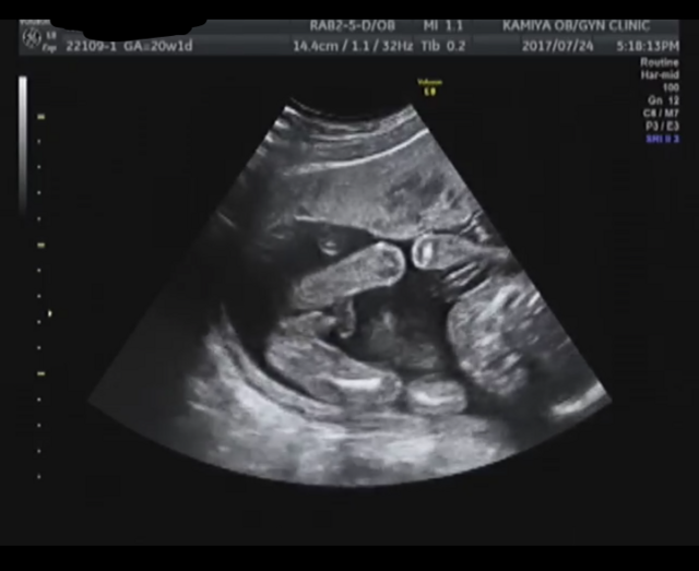 エコ―写真 15週0日 15w0d 男の子 ,妊娠,15週,エコー写真