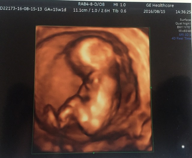 エコー写真 15週1日 15w1d 女の子,妊娠,15週,エコー写真