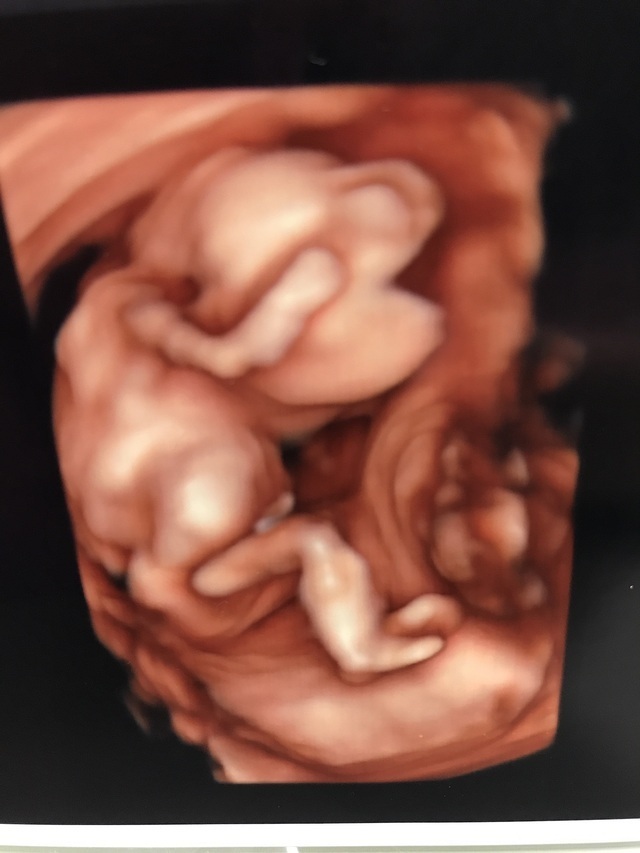 エコ―写真 15週1日 15w1d 男の子 ,妊娠,15週,エコー写真