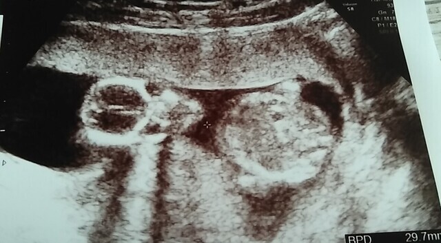 エコ―写真 15週1日 15w1d 女の子 ,妊娠,15週,エコー写真