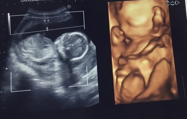 エコー写真 15週2日 15w2d 男の子,妊娠,15週,エコー写真