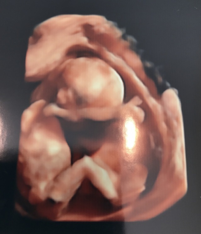 エコー写真 15週3日 15w3d 不明,妊娠,15週,エコー写真