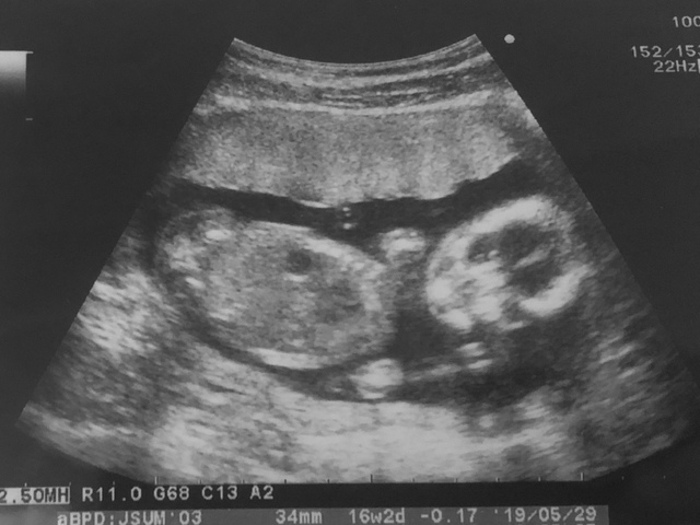 エコ―写真 15週3日 15w3d 男の子 ,妊娠,15週,エコー写真