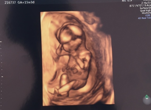 エコー写真 15週3日 15w3d 男の子,妊娠,15週,エコー写真