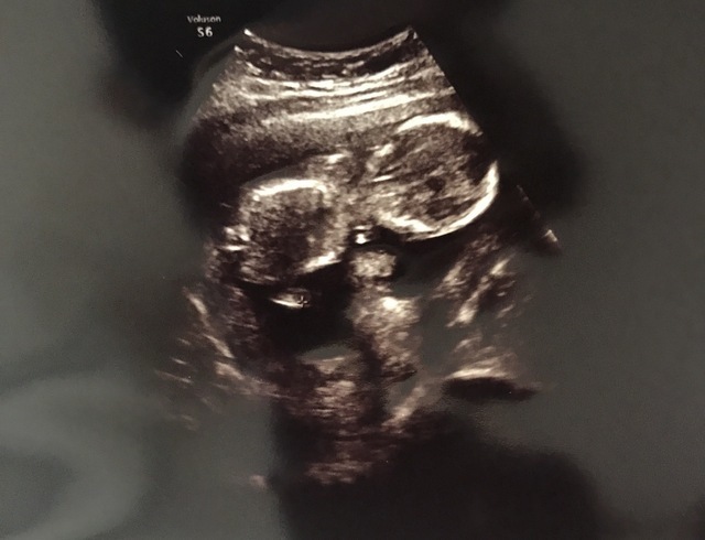 エコー写真 15週3日 15w3d 不明,妊娠,15週,エコー写真
