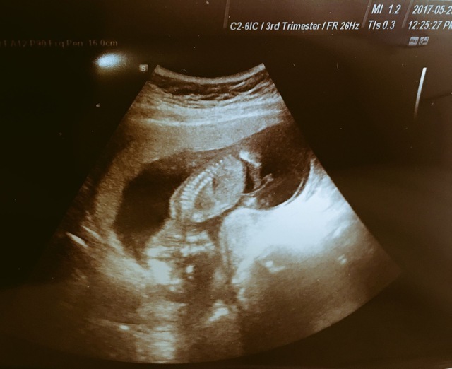 エコー写真 15週3日 15w3d 男の子,妊娠,15週,エコー写真