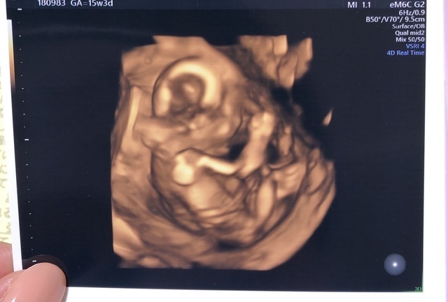 エコ―写真 15週3日 15w3d 男の子 ,妊娠,15週,エコー写真