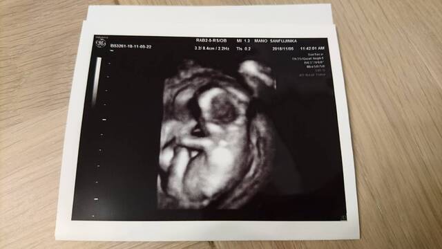 エコ―写真 15週3日 15w3d 男の子 ,妊娠,15週,エコー写真
