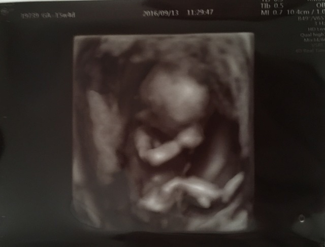 エコー写真 15週4日 15w4d 女の子,妊娠,15週,エコー写真
