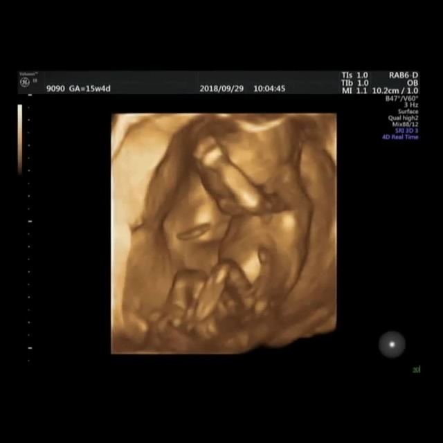 エコ―写真 15週4日 15w4d 男の子 ,妊娠,15週,エコー写真