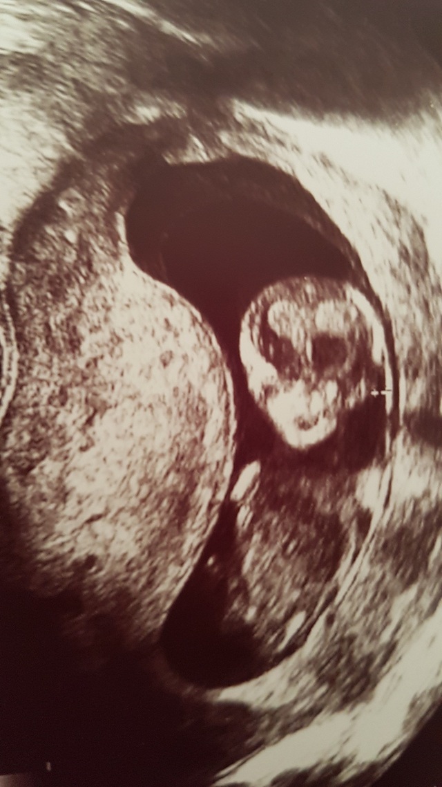 エコ―写真 15週5日 15w5d 男の子 ,妊娠,15週,エコー写真