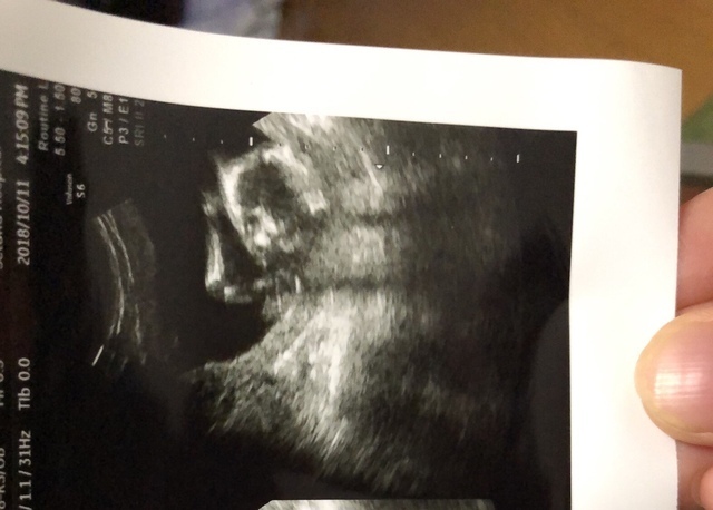 エコ―写真 15週5日 15w5d 男の子 ,妊娠,15週,エコー写真