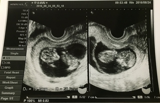 エコー写真 15週6日 15w6d 男の子 双子,妊娠,15週,エコー写真