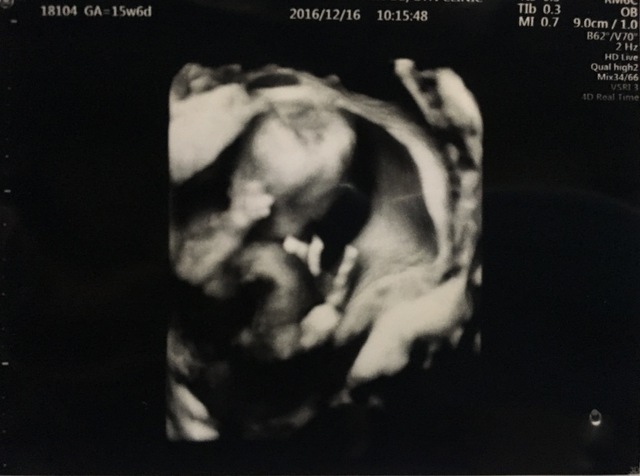 エコー写真 15週6日 15w6d 男の子 ,妊娠,15週,エコー写真