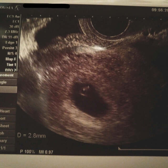 エコー写真 妊娠6週0日 6w0d不明,エコー写真,妊娠6週,