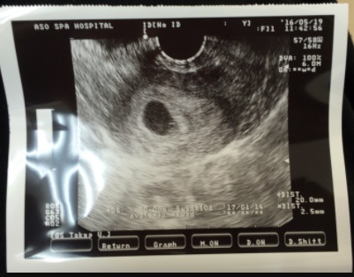 エコー写真 6週1日 6w1d 女の子,エコー写真,妊娠6週,