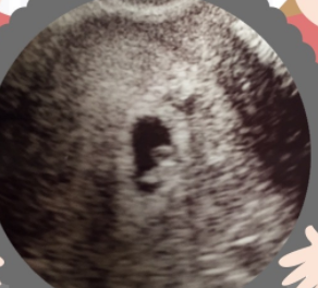 エコー写真 妊娠6週1日 6w1d 男の子,エコー写真,妊娠6週,