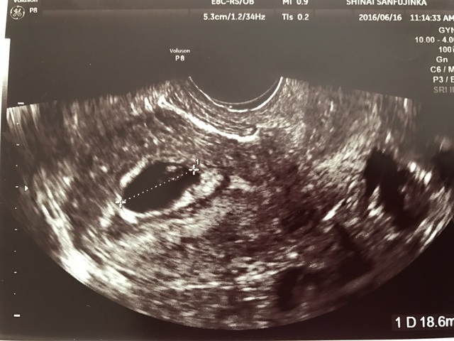 エコー写真 妊娠6週2日 6w2d 男の子,エコー写真,妊娠6週,