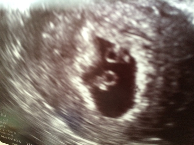 エコー写真 妊娠6週6日 6w6d 女の子,エコー写真,妊娠6週,