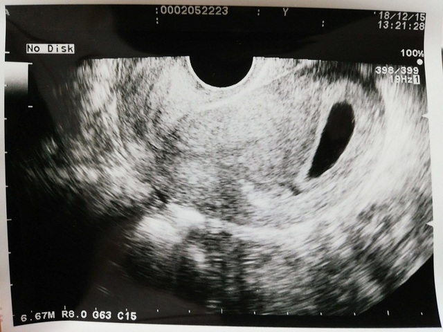 エコー写真 妊娠6週6日 6w6d 不明,エコー写真,妊娠6週,
