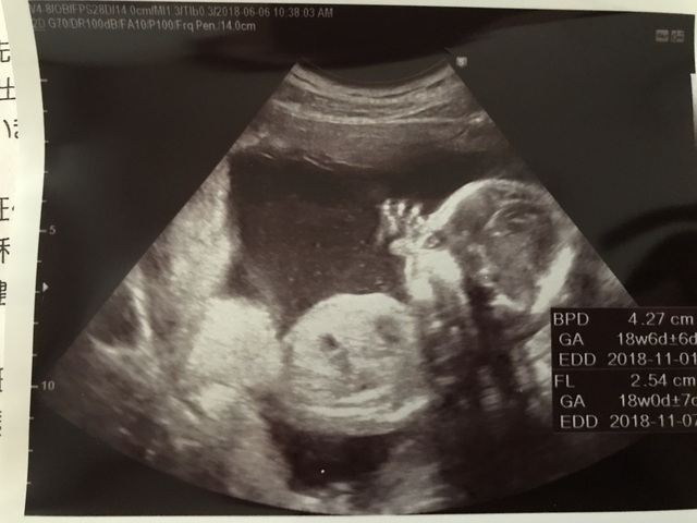 エコー写真 18週0日 18w0d 女の子,妊娠18週,エコー,