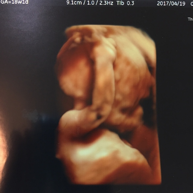 エコー写真 18週1日 18w1d 男の子,妊娠18週,エコー,