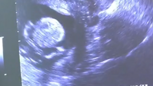 エコー写真 18週1日 18w1d 性別不明,妊娠18週,エコー,
