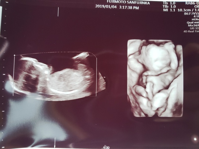 エコー写真 18週1日 18w1d 男の子,妊娠18週,エコー,