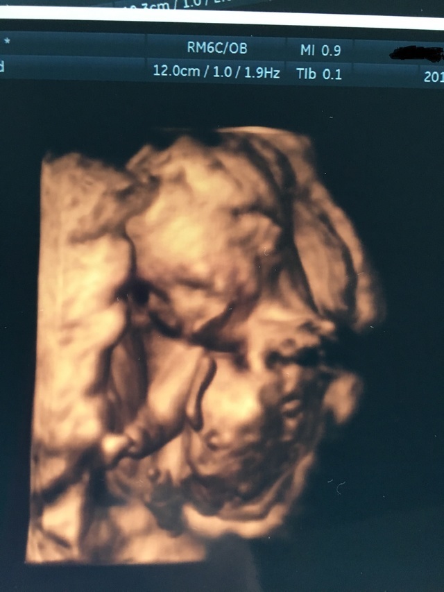 エコー写真 18週1日 18w1d 性別不明,妊娠18週,エコー,