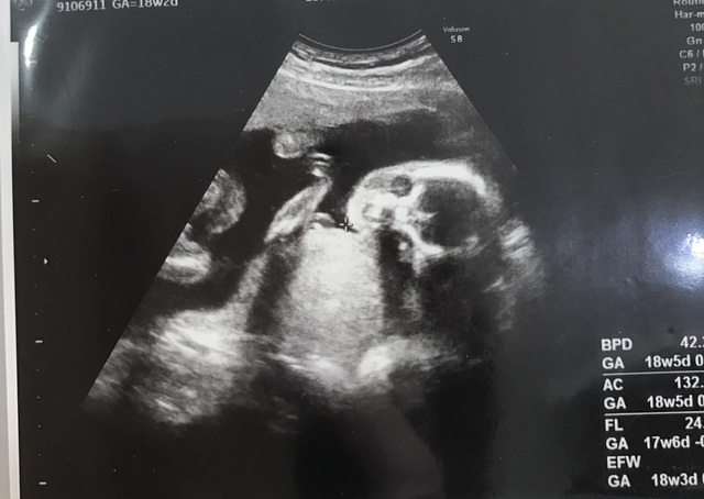 エコー写真 18週2日 18w2d 男の子,妊娠18週,エコー,